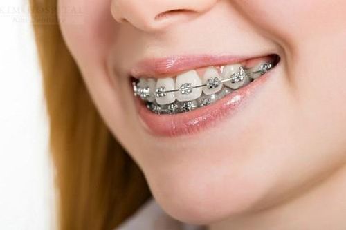 Chị em nếu đang có ý định niềng răng, hãy đọc ngay thông tin này trước rồi hẵng quyết định