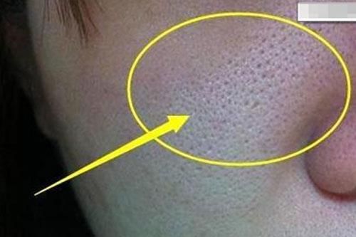 5 thói quen chăm sóc da khiến lỗ chân lông ngày càng to hơn