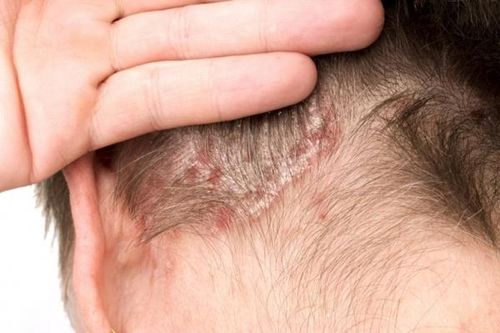 Bệnh vảy nến da đầu: Ảnh hưởng nặng nề tâm lý người bệnh