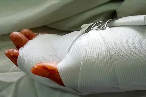 Khởi tố 2 thanh niên chém gần lìa tay đối thủ ở TP.HCM