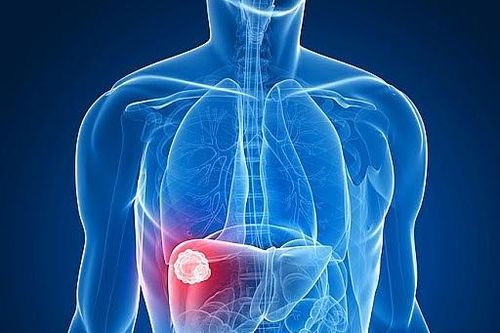 Bạn nên tầm soát ung thư gan ngay khi thấy những dấu hiệu này