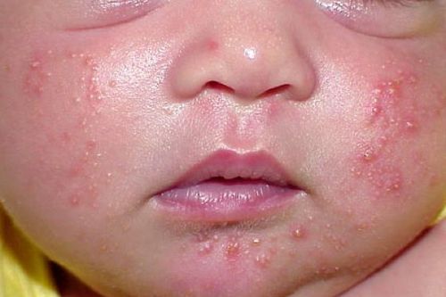 Đừng quá lo lắng khi trẻ phát ban