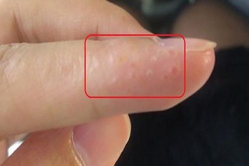 Khi bạn nhìn thấy biểu hiện này ở ngón tay hãy đi khám gấp kẻo hối hận thì đã quá muộn