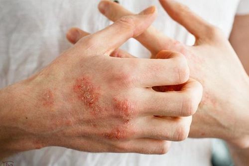 Bệnh ghẻ lây qua quan hệ tình dục và tiếp xúc gần