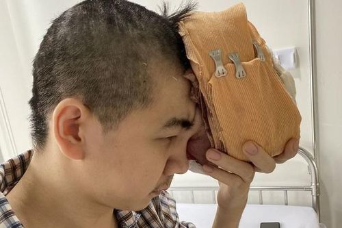 Cứu nam thanh niên phải dùng tay đỡ khối u khổng lồ trên mặt