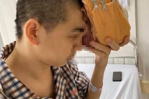 Phẫu thuật thành công khối u khổng lồ xâm lấn vùng trán và mắt trái