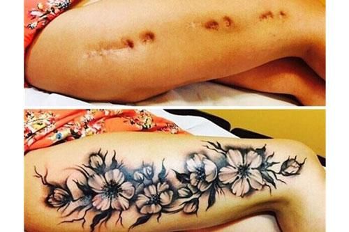 Không may để lại sẹo xấu xí trên cơ thể, hãy 'thủ tiêu' chúng bằng cách làm 'cực độc'này
