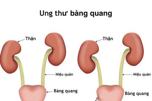 Dấu hiệu nhận biết ung thư bàng quang