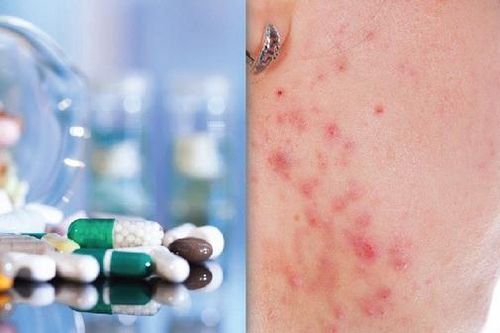 Thuốc hạ mỡ máu có thể gây viêm xơ cứng và tràn dịch màng bồ đào