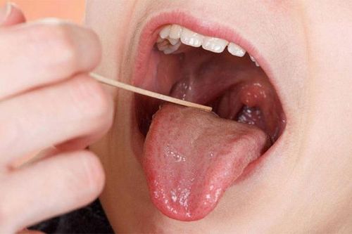 Ung thư lưỡi có thể phát hiện sớm?