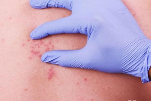Đề phòng biến chứng do zona thần kinh