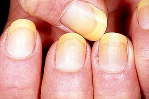 Đặc biệt chú ý nếu móng tay xuất hiện điều này, dấu hiệu cảnh báo cơ thể đang mắc một số bệnh nguy hiểm