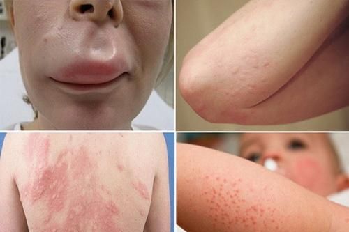 Dị ứng thời tiết: những điều cần biết
