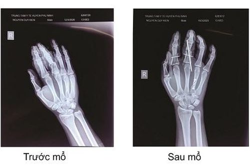 Trung tâm Y tế Phù Ninh, Phú Thọ phẫu thuật đa xương bàn tay sau TNGT