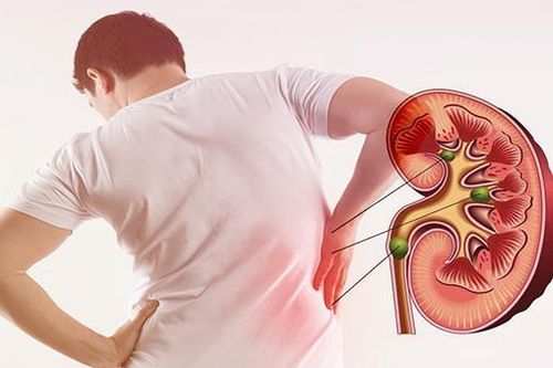 Tránh ăn gì khi bị sỏi thận?