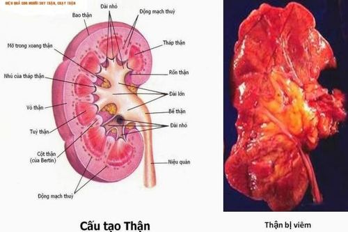 Viêm cầu thận cấp: Phát hiện sớm, điều trị nhanh