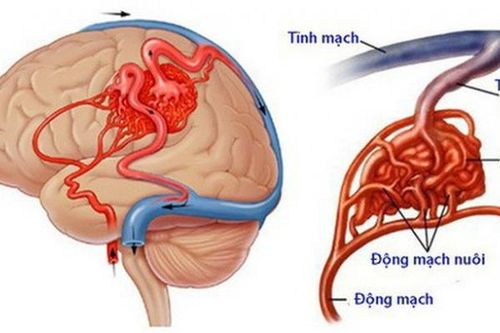 Dị dạng mạch não biểu hiện thế nào?
