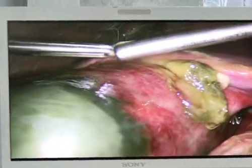Bệnh viện Đa khoa Hưng Thịnh: Cấp cứu thành công trường hợp viêm phúc mạc mật