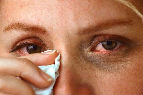 Mắt đỏ có thể là triệu chứng của COVID-19