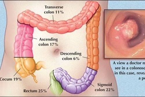 Phát hiện sớm ung thư đại trực tràng