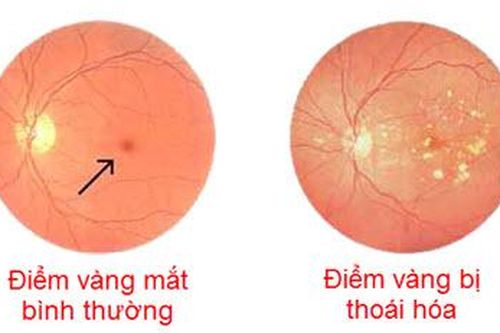 Tìm ra protein giúp điều trị bệnh thoái hóa điểm vàng