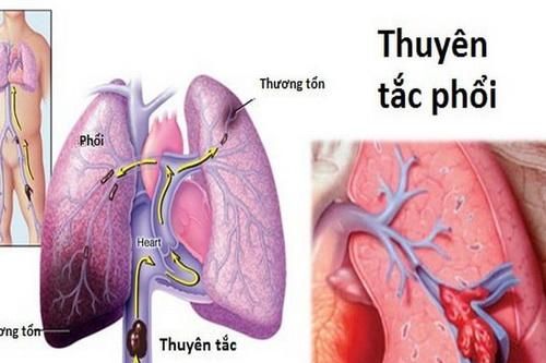 Nhận biết sớm huyết khối tĩnh mạch sâu