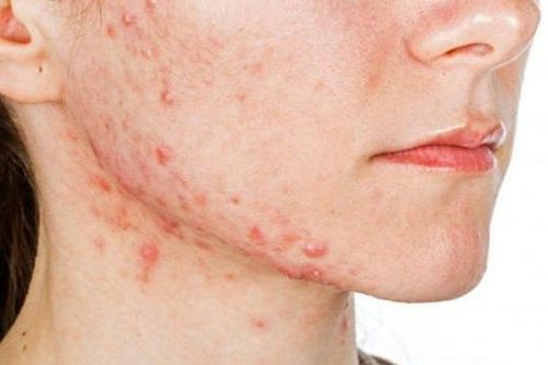 Làm gì khi bị trứng cá?