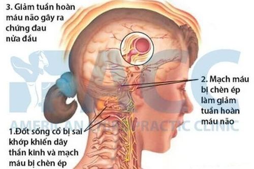 Chứng đau nửa đầu và cách xử trí