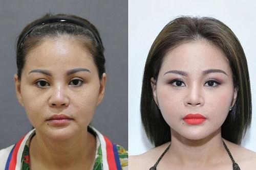 Gương mặt Lê Giang biến đổi sau 20 lần 'dao kéo'