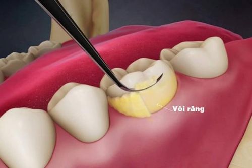 Bệnh nha chu có nguy hiểm?