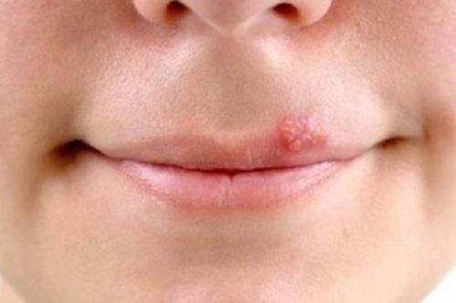 Rộp môi có lây không?
