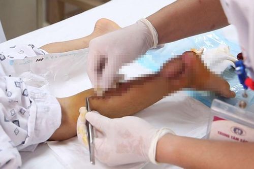 Bé trai bị nan hoa xe đạp chém mất vạt da ở gót chân