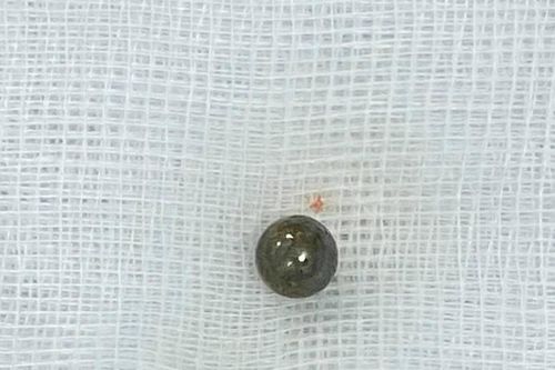 Liệt nửa người vì bị súng tự chế bắn xuyên não