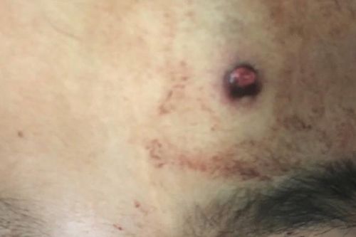 Bệnh việt Việt Đức cứu sống bệnh nhân bị bắn xuyên não