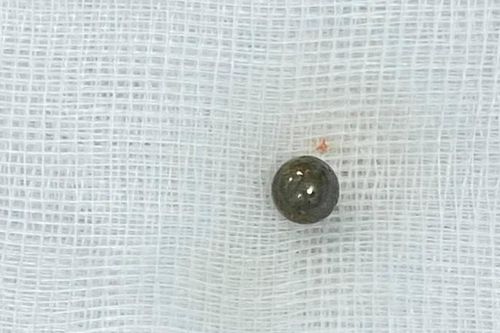Sử dụng súng tự chế, một thanh niên bị đạn bắn xuyên não