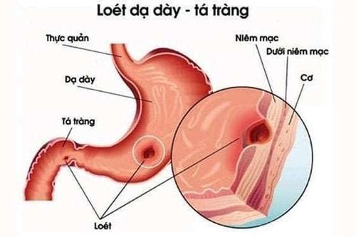 Kết hợp đông, tây y trong điều trị viêm loét dạ dày - tá tràng