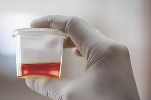 Đi tiểu ra máu, chớ chủ quan với 7 căn bệnh nguy hiểm chết người này