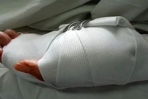 Ngồi trong nhà, 1 phụ nữ bị nhóm thanh niên xông vào chém đứt ngón tay