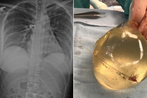 Cô gái bị bắn xuyên ngực, sống sót thần kỳ nhờ túi nâng ngực cản đạn