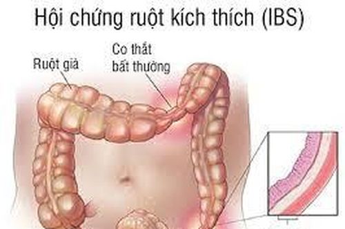 Nhận biết hội chứng ruột kích thích