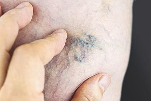 Dịch COVID-19, bệnh nhân suy tĩnh mạch mạn tính cần lưu ý gì?