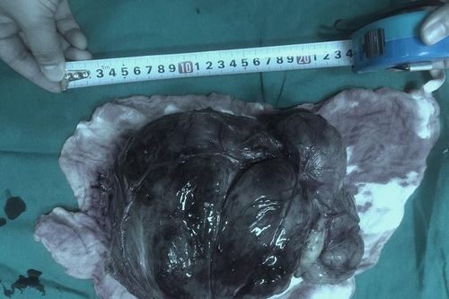 Phẫu thuật thành công, cứu sống bệnh nhân có khối u nặng 4,3kg