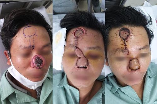 Kỳ diệu tái tạo mũi cho bệnh nhân ung thư bị xâm lấn đường thở