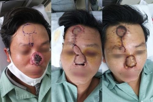 Từ cục mụn nhỏ trên mũi, người đàn ông đi khám bàng hoàng hóa ung thư