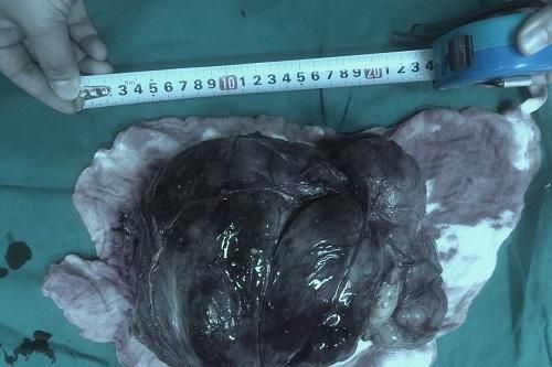 Người phụ nữ phát hiện u mạc treo lớn nhờ... đau bụng