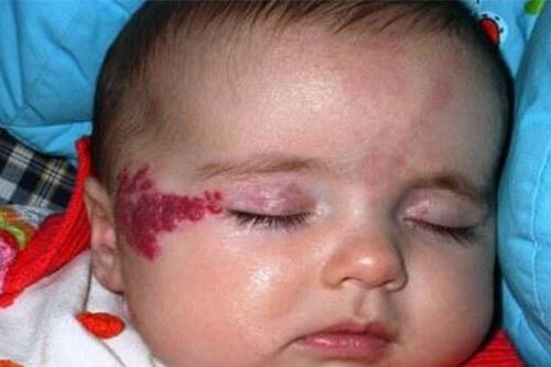 Khi con bị u máu sơ sinh, nên làm gì?