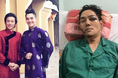 Con trai nuôi Hoài Linh được phẫu thuật nối xương hàm thành công