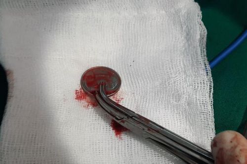 Cứu sống bệnh nhân bị hóc đồng xu