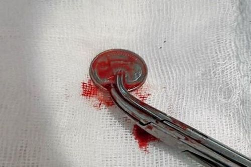 Cứu sống nam bệnh nhân bị đồng xu chèn ép khí quản