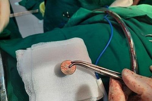 Chơi trò tung hứng nam thanh niên 36 tuổi nuốt luôn đồng bạc cắc